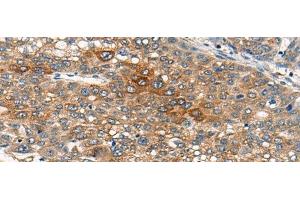 Immunohistochemistry of paraffin-embedded Human liver cancer tissue using B4GAT1 Polyclonal Antibody at dilution of 1:110(x200) (B3GNT1 抗体)