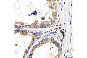 Immunohistochemistry of paraffin-embedded human stomach cancer using F antibody (ABIN6129515, ABIN6140420, ABIN6140421 and ABIN6220936) at dilution of 1:200 (40x lens). (FABP3 抗体  (AA 1-133))