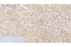 Immunohistochemistry of paraffin-embedded Human uterus cancer tissue using HSP70 Monoclonal Antibody at dilution of 1:200. (HSP70 抗体)