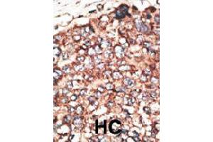 Formalin-fixed and paraffin-embedded human hepatocellular carcinoma tissue reacted with MMP17 polyclonal antibody  , which was peroxidase-conjugated to the secondary antibody, followed by DAB staining. (MMP17 抗体  (Internal Region))
