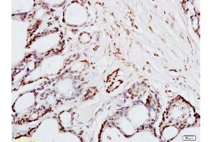 Formalin-fixed and paraffin embedded human colon carcinoma tissue labeled with Anti-FRA2/FOSL2 Polyclonal Antibody, Unconjugated  at 1:200 followed by conjugation to the secondary antibody and DAB staining (FOSL2 抗体  (AA 231-326))