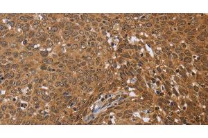Immunohistochemistry of paraffin-embedded Human cervical cancer using FKBP8 Polyclonal Antibody at dilution of 1:50