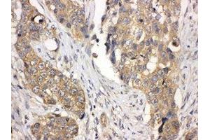 IHC-P: LASP1 antibody testing of human lung cancer tissue (LASP1 抗体  (AA 16-30))