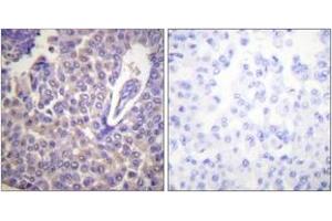 Immunohistochemistry analysis of paraffin-embedded human breast carcinoma, using Calnexin (Phospho-Ser583) Antibody. (Calnexin 抗体  (pSer583))