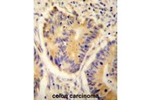 ADH4 antibody(C-term) immunohistochemistry analysis in formalin fixed and paraffin embedded human colon carcinoma followed by peroxidase conjugation of the secondary antibody and DAB staining. (ADH4 抗体  (C-Term))