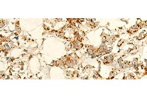 Immunohistochemistry of paraffin-embedded Human breast cancer tissue using NAPRT Polyclonal Antibody at dilution of 1:50(x200) (NAPRT1 抗体)