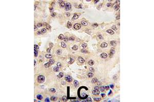 Formalin-fixed and paraffin-embedded human lung carcinoma tissue reacted with EN1 polyclonal antibody  , which was peroxidase-conjugated to the secondary antibody, followed by DAB staining. (EN1 抗体  (N-Term))
