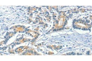 Immunohistochemistry of paraffin-embedded Human colon cancer using ASAH2 Polyclonal Antibody at dilution of 1:50 (ASAH2 抗体)