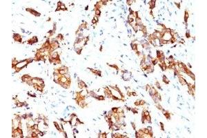 Formalin-fixed, paraffin-embedded human breast carcinoma stained with HSP27 antibody (HSPB1/774) (HSP27 抗体)