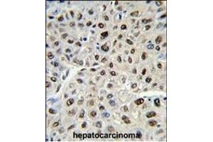 Formalin-fixed and paraffin-embedded human hepatocarcinoma reacted with SSB Antibody (C-term) (ABIN389303 and ABIN2839423) , which was peroxidase-conjugated to the secondary antibody, followed by DAB staining. (SSB 抗体  (C-Term))