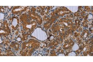 Immunohistochemistry of paraffin-embedded Human thyroid cancer tissue using MEIS1 Polyclonal Antibody at dilution 1:30 (MEIS1 抗体)