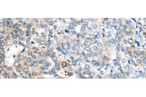 Immunohistochemistry of paraffin-embedded Human liver cancer tissue using CES2 Polyclonal Antibody at dilution of 1:55(x200) (CES2 抗体)