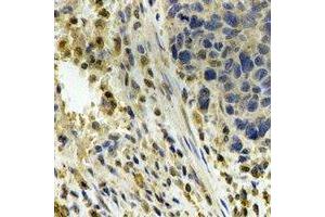 Immunohistochemical analysis of ALDH4A1 staining in human esophageal cancer formalin fixed paraffin embedded tissue section. (ALDH4A1 抗体)