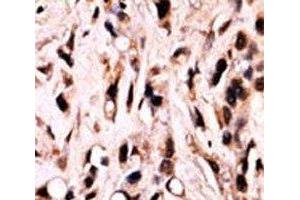 IHC analysis of FFPE breast carcinoma stained with phospho-SMAD4 antibody. (SMAD4 抗体  (pThr277))