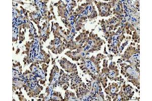 IHC analysis of Thymidylate Synthase/TYMS using anti-Thymidylate Synthase/TYMS antibody (ABIN7599260).