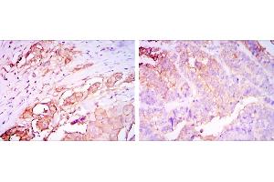 Immunohistochemical analysis of paraffin-embedded rectum cancer tissues (left) and stomach cancer tissues (right) using CEA mouse mAb with DAB staining. (CEA 抗体)