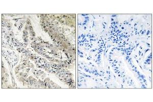Immunohistochemistry analysis of paraffin-embedded human lung carcinoma tissue, using CRBP III antibody. (Retinol Binding Protein 5 抗体  (N-Term))