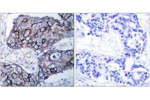 Immunohistochemistry analysis of paraffin-embedded human breast carcinoma tissue, using Integrin beta3 (Ab-785) Antibody. (Integrin beta 3 抗体  (AA 739-788))