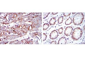 Immunohistochemical analysis of paraffin-embedded stomach cancer tissues (left) and stomach tissues (right) using KRT19 mouse mAb with DAB staining. (Cytokeratin 19 抗体)