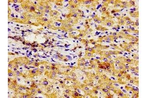 Immunohistochemistry of paraffin-embedded human liver cancer using ABIN7145059 at dilution of 1:100 (NPR3 抗体  (AA 36-127))