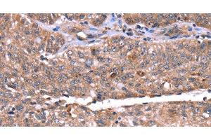 Immunohistochemistry of paraffin-embedded Human ovarian cancer tissue using HRG Polyclonal Antibody at dilution 1:50 (HRG 抗体)