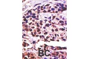 Formalin-fixed and paraffin-embedded human cancer tissue reacted with the primary antibody, which was peroxidase-conjugated to the secondary antibody, followed by DAB staining. (USP25 抗体  (C-Term))