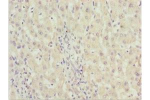Immunohistochemistry of paraffin-embedded human liver cancer using ABIN7176530 at dilution of 1:100 (ZNF785 抗体  (AA 1-200))
