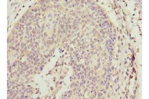 Immunohistochemistry of paraffin-embedded human cervical cancer using ABIN7143769 at dilution of 1:100 (ALG2 抗体  (AA 197-416))