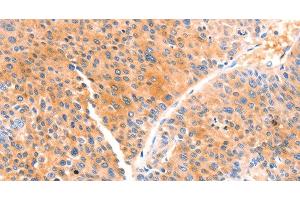 Immunohistochemistry of paraffin-embedded Human liver cancer using PRDX2 Polyclonal Antibody at dilution of 1:80 (Peroxiredoxin 2 抗体)