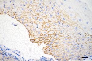 Immunohistochemistry was performed on paraffin-embedded human esophageal carcinoma using desmocollin 3 antibody (ABIN7798316), 1:200).