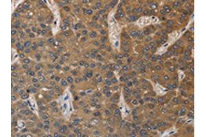 The image on the left is immunohistochemistry of paraffin-embedded Human liver cancer tissue using ABIN7129190(DEGS1 Antibody) at dilution 1/40, on the right is treated with fusion protein. (DEGS1 抗体)