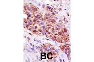 Formalin-fixed and paraffin-embedded human cancer tissue reacted with the primary antibody, which was peroxidase-conjugated to the secondary antibody, followed by DAB staining. (UBE2B 抗体  (C-Term))