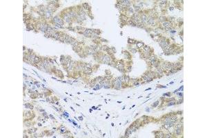 Immunohistochemistry of paraffin-embedded Human liver cancer using TIMM10B Polyclonal Antibody at dilution of 1:100 (40x lens). (TIMM10B 抗体)