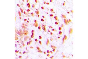 Immunohistochemical analysis of Histone H4 (AcK16) staining in human lung cancer formalin fixed paraffin embedded tissue section. (Histone H4 抗体  (acLys16, N-Term))