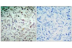 Immunohistochemical analysis of paraffin- embedded human breast carcinoma tissue, using Rb (phospho-Ser780) antibody (E011132) . (Retinoblastoma 1 抗体  (pSer780))
