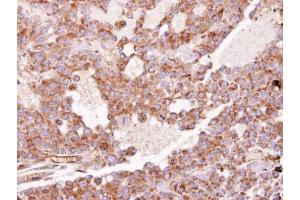 IHC-P Image Immunohistochemical analysis of paraffin-embedded HUH7 xenograft, using RhoGDI, antibody at 1:100 dilution. (ARHGDIA 抗体)