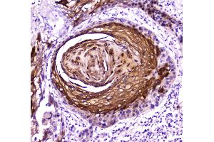 IHC analysis of FABP5 using anti-FABP5 antibody . (FABP5 抗体)