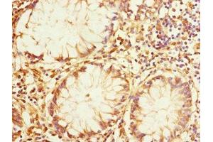 Immunohistochemistry of paraffin-embedded human colon cancer using ABIN7167162 at dilution of 1:100 (IQGAP3 抗体  (AA 1437-1631))