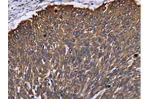 The image on the left is immunohistochemistry of paraffin-embedded Human lung cancer tissue using ABIN7130044(KRT31 Antibody) at dilution 1/30, on the right is treated with fusion protein. (Keratin 31 抗体)