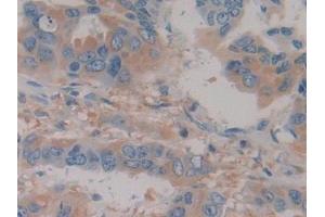 Detection of Hpt in Human Breast cancer Tissue using Polyclonal Antibody to Haptoglobin (Hpt) (Haptoglobin 抗体  (AA 44-157))