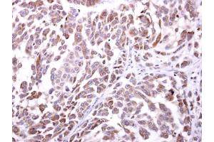 IHC-P Image NKG2D antibody [N3C2], Internal detects NKG2D protein at cytosol on human lung carcinoma by immunohistochemical analysis. (KLRK1 抗体  (Internal Region))