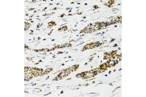 Immunohistochemistry of paraffin-embedded human breast cancer using HSPA9 antibody (ABIN5970207) at dilution of 1/100 (40x lens). (HSPA9 抗体)