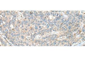 Immunohistochemistry of paraffin-embedded Human liver cancer tissue using CASR Polyclonal Antibody at dilution of 1:60(x200) (CASR 抗体)