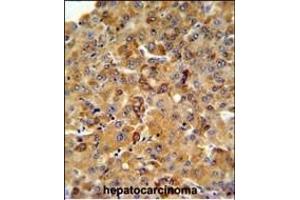SFT2D3 Antibody (N-term) (ABIN651461 and ABIN2840253) IHC analysis in formalin fixed and paraffin embedded human hepatocarcinoma followed by peroxidase conjugation of the secondary antibody and DAB staining. (SFT2D3 抗体  (N-Term))