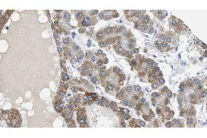 ABIN6269057 at 1/100 staining Human liver cancer tissue by IHC-P.