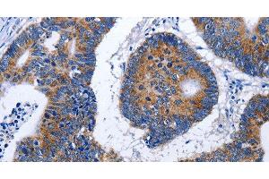 Immunohistochemistry of paraffin-embedded Human colon cancer using EEF1 gamma Polyclonal Antibody at dilution of 1:50 (EEF1G 抗体)