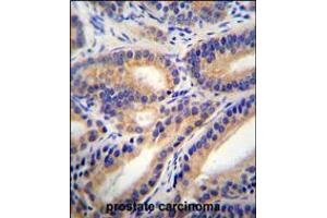 HSD11B1L Antibody immunohistochemistry analysis in formalin fixed and paraffin embedded human prostate carcinoma followed by peroxidase conjugation of the secondary antibody and DAB staining. (HSD11B1L 抗体  (C-Term))