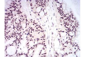 Immunohistochemical analysis of paraffin-embedded colon cancer tissues using DNMT1 mouse mAb with DAB staining. (DNMT1 抗体  (AA 1317-1616))