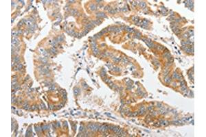 The image on the left is immunohistochemistry of paraffin-embedded Human colon cancer tissue using ABIN7128369(ALPI Antibody) at dilution 1/25, on the right is treated with fusion protein. (Intestinal Alkaline Phosphatase 抗体)