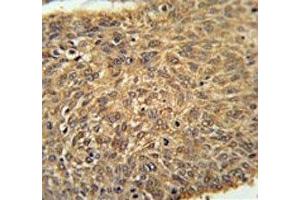 ATG13 antibody immunohistochemistry analysis in formalin fixed and paraffin embedded human lung carcinoma. (ATG13 抗体  (AA 1-30))